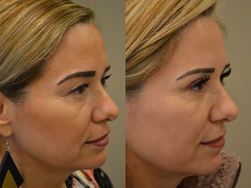 upper blepharoplasty before after