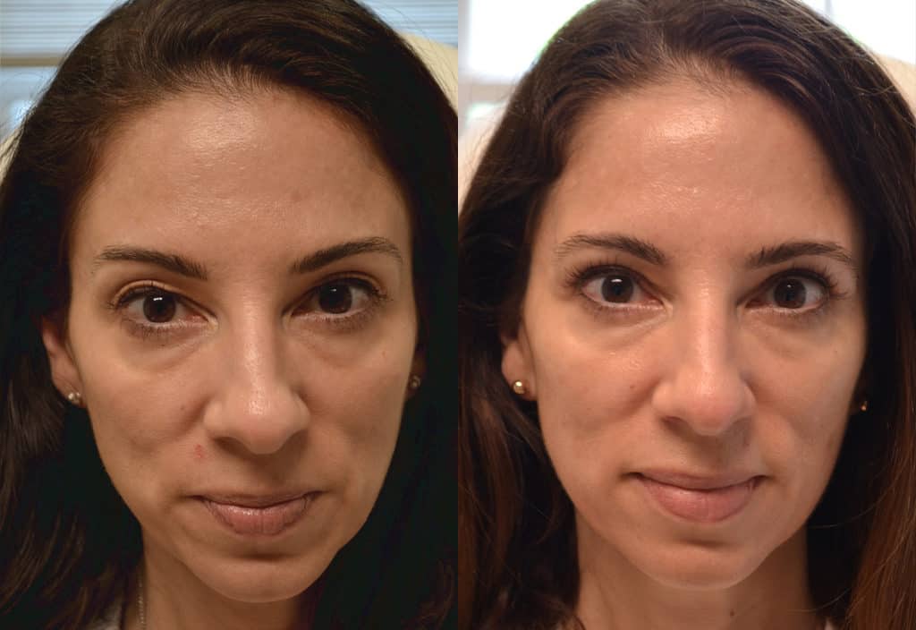 upper blepharoplasty before after